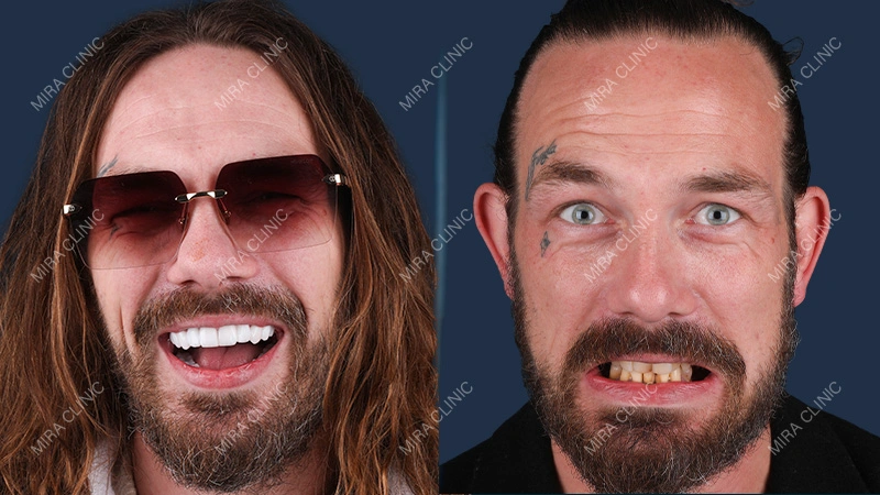 smile makeover Before and After